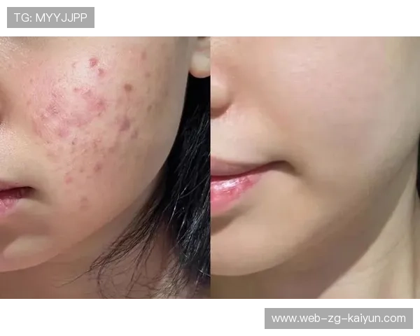运动与痘痘:为什么运动后长痘,为什么运动完后痘痘变明显了 运动与痘痘:为什么运动后长痘,为什么运动完后痘痘变明显了